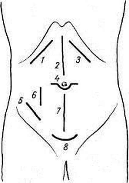 Брюшная стенка после операции. Грыжа спигелиевой линии живота операция. Разрезы при пупочной грыже. Разезы при пупочной грыжи.