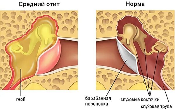 Острый Гнойный средний отит барабанная перепонка. Наружный отит барабанная перепонка. Экссудативный отит перепонка. Гнойный средний отит барабанная перепонка. Правосторонний гнойный