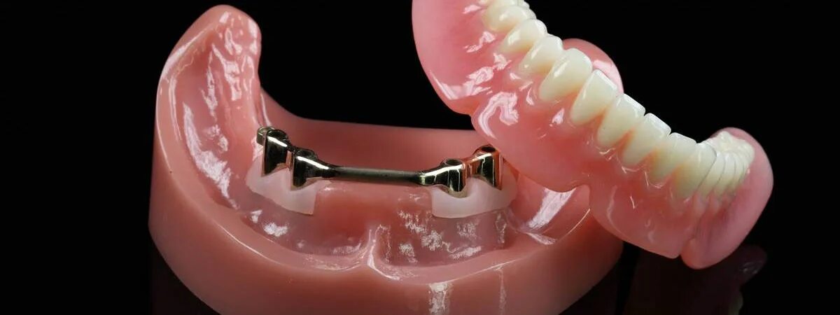 Металлопластмассовый протез на имплантах. Съемный протез на имплантах. Балочный протез на 4. Полный покрывной протез на балке на 4-х имплантах. Балочный протез на 4.