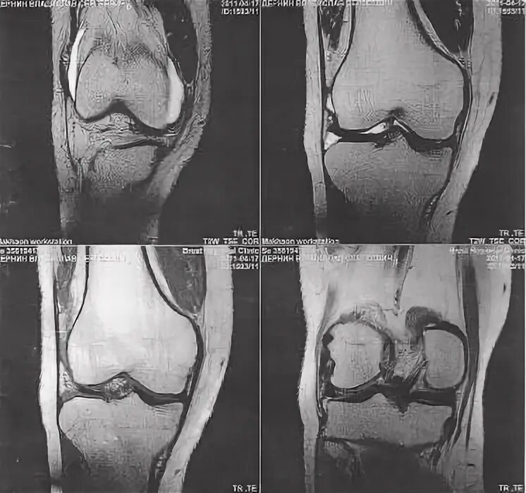 Разрыв мениска мрт. Снимок мрт колена разрыв мениска. Повреждение мениска коленного сустава мрт.