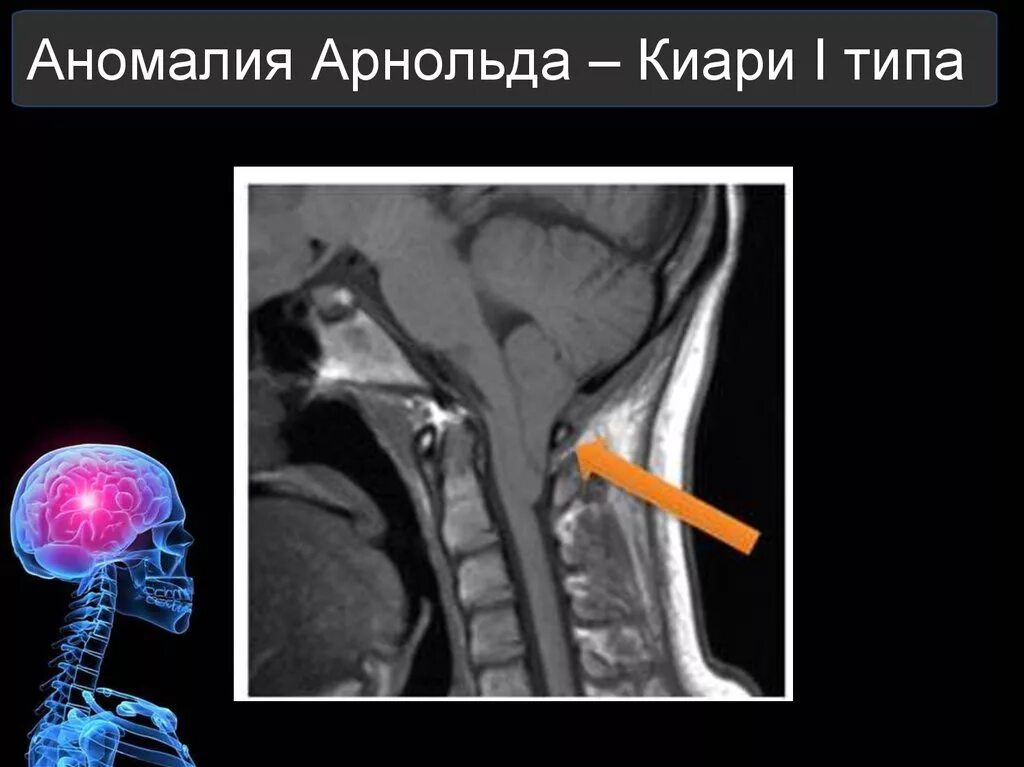 Аномалия киари степени. Синдром Арнольда-Киари 1. Врожденная аномалия Арнольда Киари. Аномалия Киари сирингомиелия.