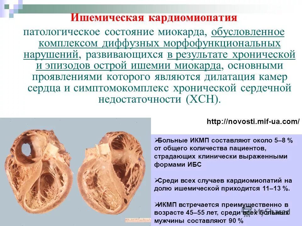 Отличие ишемии. Сердечной недостаточности кардиомиопатии. Ишемическая кардиомиопатия. Ишемическая дилатационная кардиомиопатия. Кардиомиопатия ишемическая смерть.