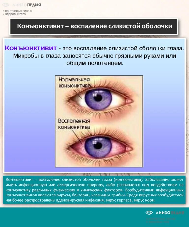 Что можно при конъюнктивите. Трахома. Конъюнктивит. Кератит. Блефарит.. Аллергический конъюнктивит или кератоконъюнктивит. Вирусный конъюнктивит возбудитель. Герпесный конъюнктивит конъюнктивит.