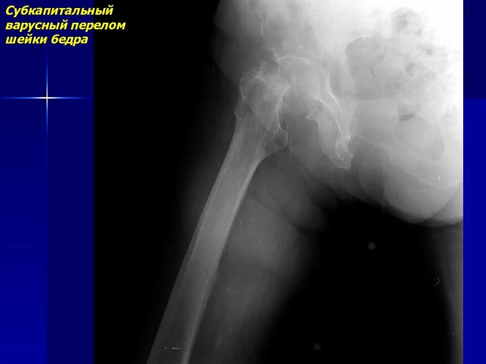 Трансцервикальный перелом бедренной кости. Аддукционный перелом шейки бедра рентген. Трансцервикальный перелом бедренной кости. Трансцервикальный перелом бедренной кости. Трансцервикальный перелом шейки бедра рентген.