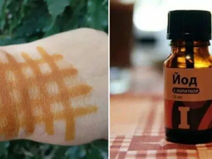 Можно мазать синяки йодом