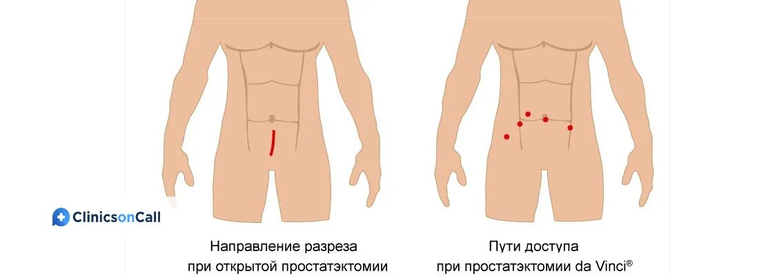 Удаление простаты да винчи. Роботическая простатэктомия. Радикальная простатэктомия операция. Схема операции простатэктомии.