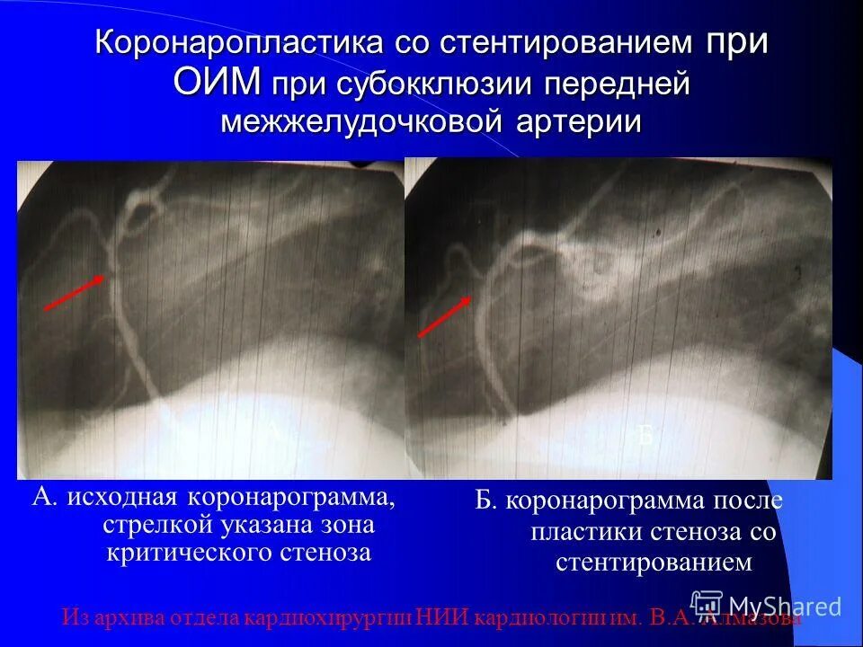 Острый инфаркт миокарда стентирование. No reflow феномен чкв. Стент для коронарных артерий. Окклюзия передней межжелудочковой артерии. Стентирование миокарда.