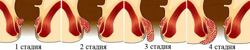 Выпадения геморроидальных узлов II - III степени. Геморроидальный узел 4 степени. Начальная стадиягемороя. Начальная стадия геморроя.