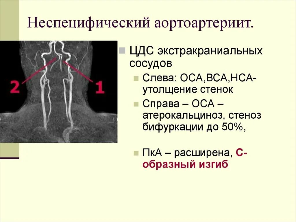 Стеноз устья вса. Неспецифический аортоартериит. Неспецифический аортоартериит презентация.