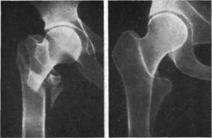 Чрезвертельный перелом бедренной кости рентген. Вколоченный перелом шейки бедра рентген. Вколоченный перелом шейки бедра. Межвертельный перелом бедренной кости рентген. Шейка бедра лечение без операции