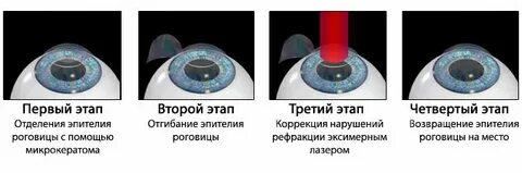 Что можно делать после коррекции зрения
