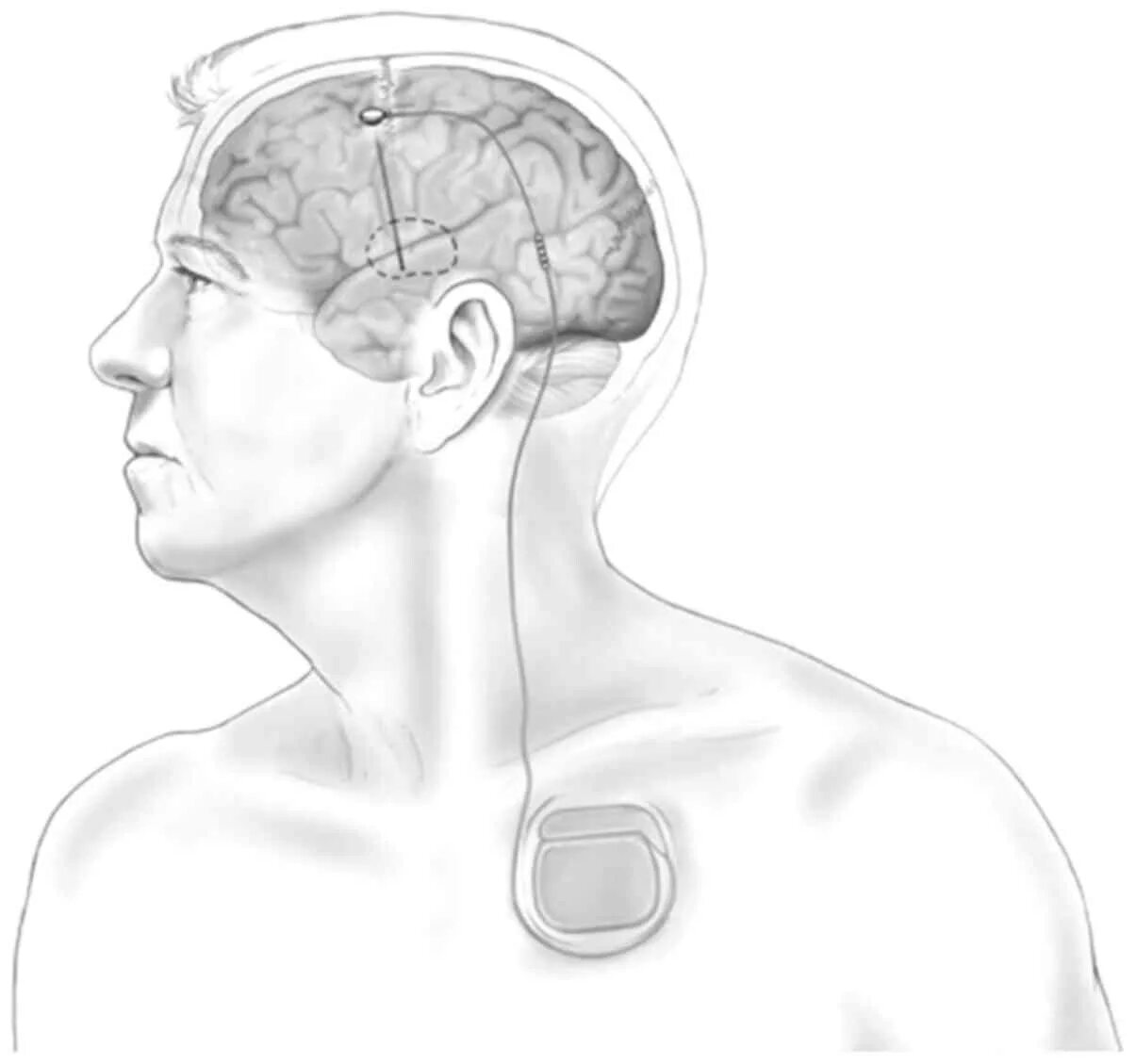 Deep brain. Электроды нейростимулятора спинного мозга. Стимулятор головного мозга. Электроды в головной мозг. Глубинная стимуляция головного мозга.