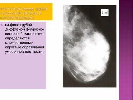 Диффузно железисто фиброзная мастопатия