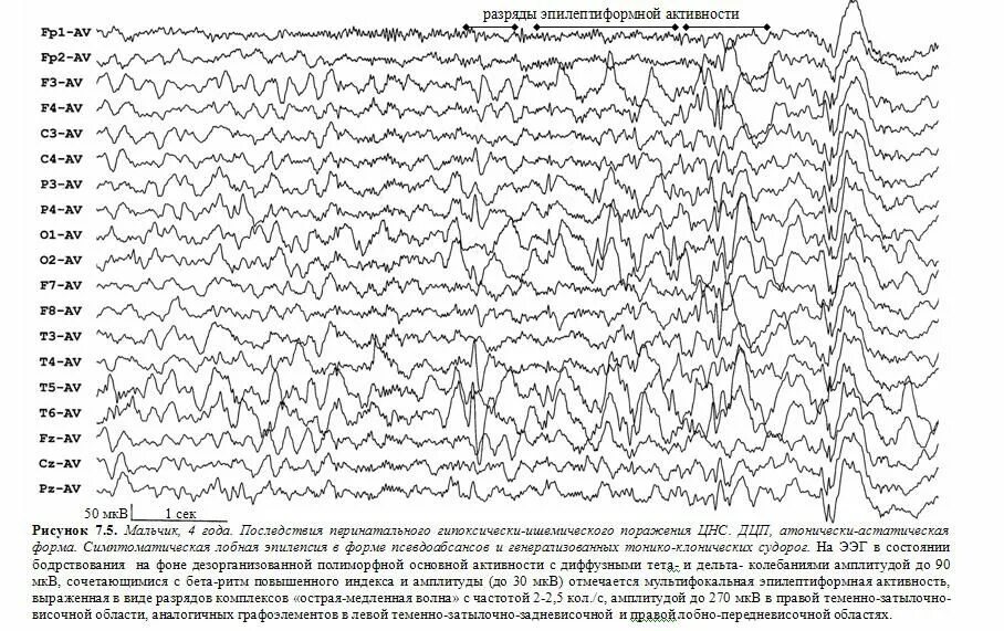 Спайки на ээг. Пик волна на ЭЭГ. Пик полипик волна на ЭЭГ. Острые волны на ЭЭГ. Острая волна медленная волна на ЭЭГ.