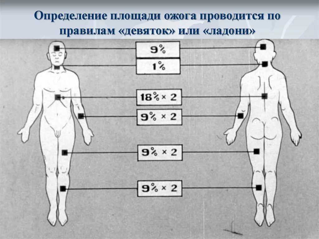 Ожоги проценты поражения. Определение площади ожога. Ожоги площадь поражения. Определениелощади ожога.