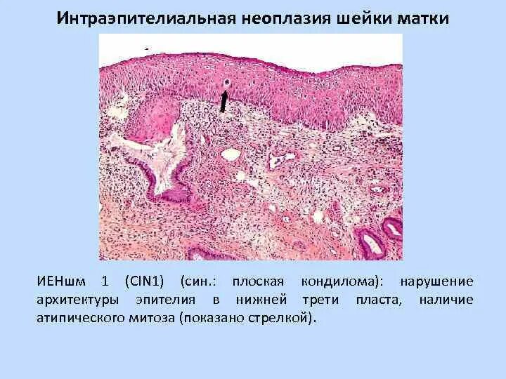 Неоплазия лечение. Дисплазия эпителия 3 степени. Дисплазия шейки гистология. Цервикальная интраэпителиальная неоплазия (Cin). Неоплазия эпителия матки.