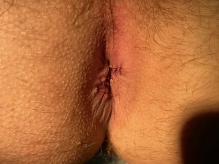 После лечения геморроя операцией. 