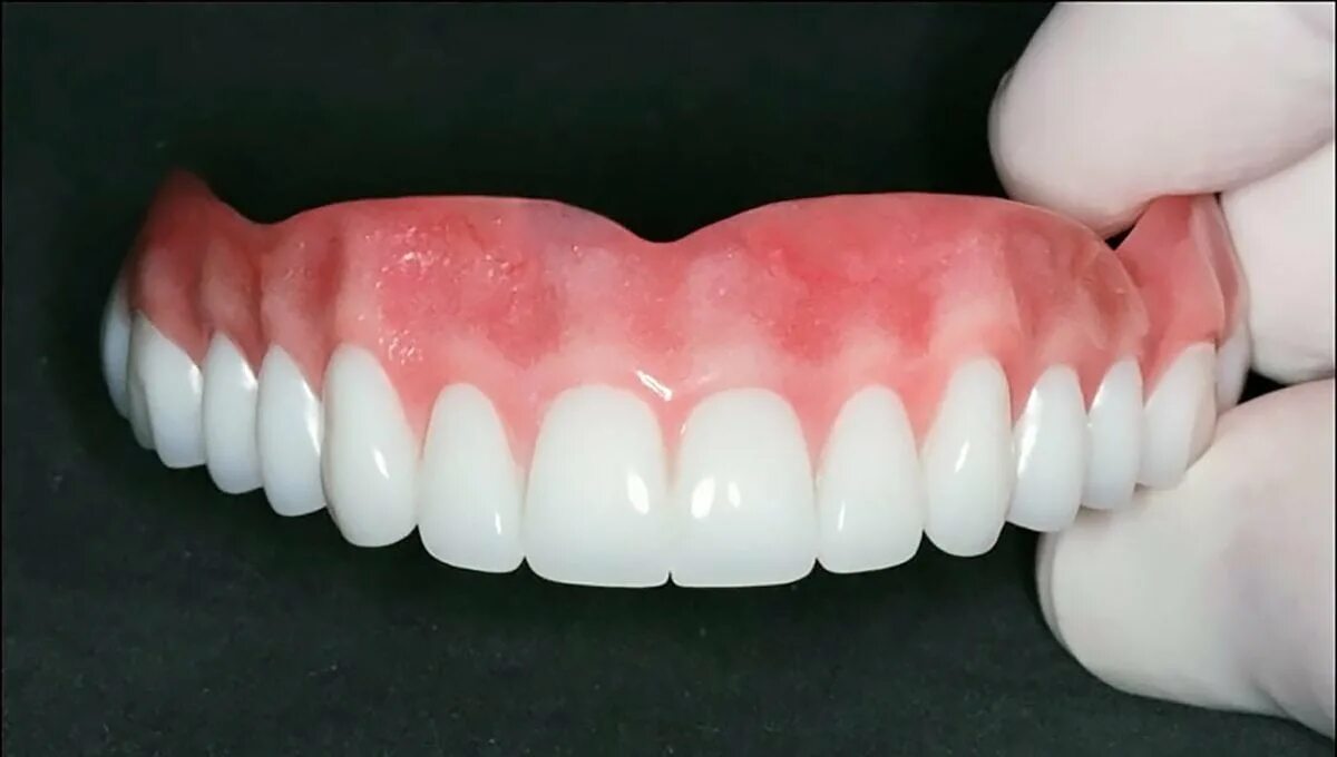 Зубные протезы нового поколения цена. Квадротти зубные протезы. Протезы Квадротти без неба. Съемный протез (6-14 зубов) термо Джет. Верхний съемный зубной протез.