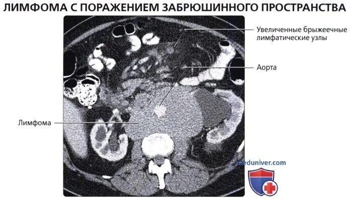 Что входит в мрт забрюшинного пространства. Мрт анатомия забрюшинного пространства. лимфома забрюшинного пространства кт. забрюшинное образование на кт.