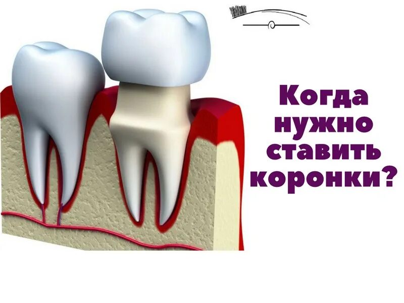 Почему ставят коронки. Как ставится коронка на зуб.