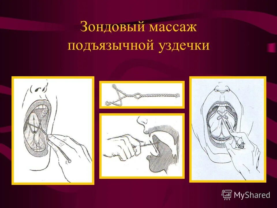 Логопедический массаж по новиковой методика. Логопедические зонды для массажа языка. Зондовый массаж языка для детей. Массаж языка логопедический. Зонд для массажа языка.