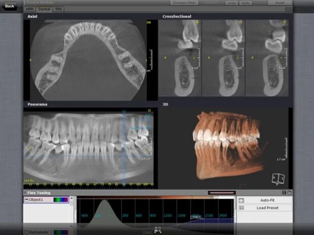 Где сделать кт зуба. Сканер челюстей 3 d модель. Компьютерная томография челюсти.