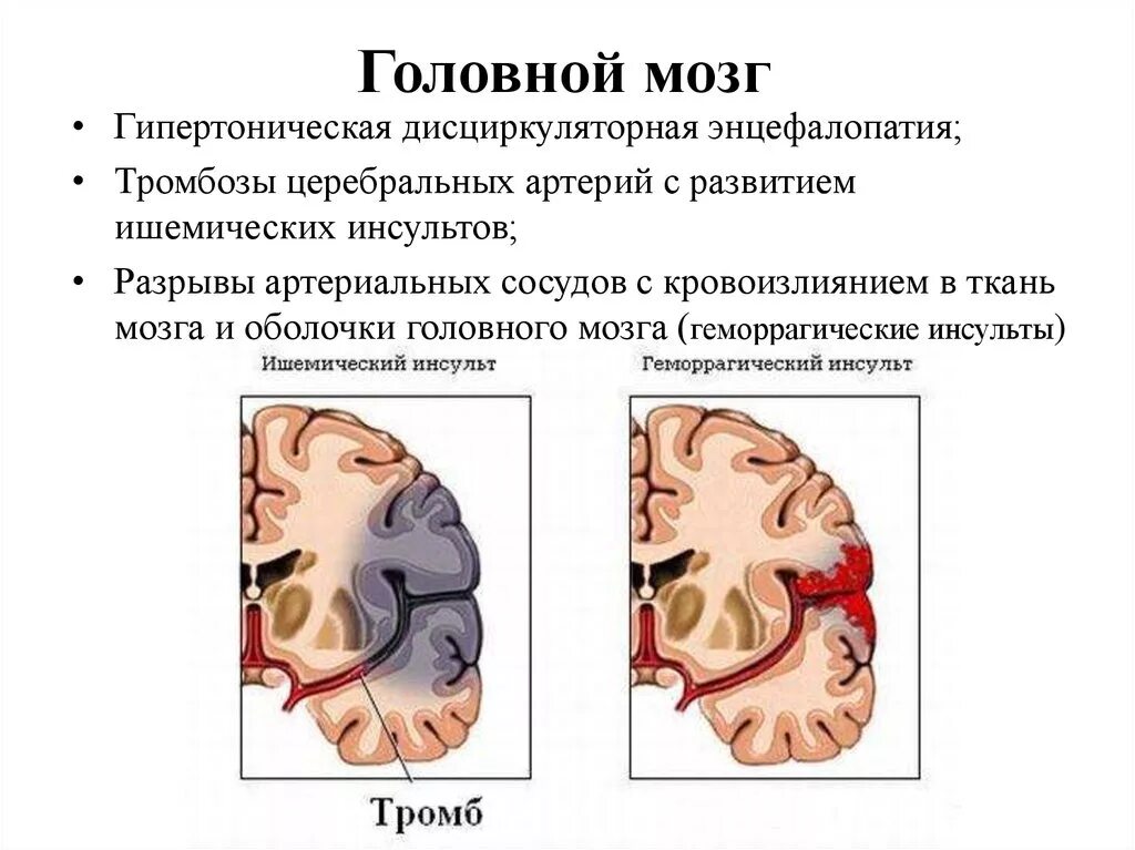 Энцефалопатия головного мозга что это такое. Гипертоническая дисциркуляторная энцефалопатия. Дисциркуляторная энцефалопатия головного мозга. Острая энцефалопатия головного мозга.