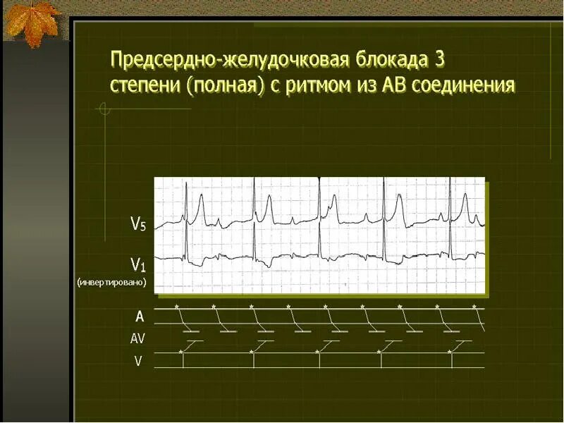 Что значит полная блокада. Предсердно-желудочковая блокада 1 степени. Предсердно-желудочковая блокада 2 степени. Предсердножелудочковая блакада. Полная предсердно желудочковая блокада ЭКГ.