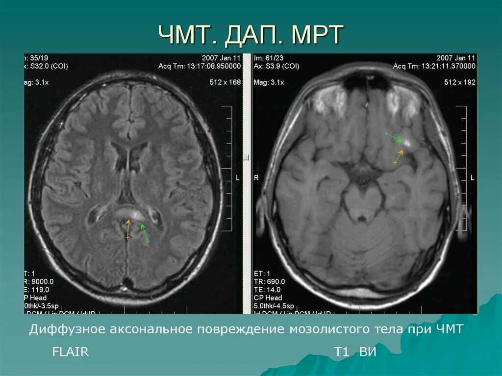 Аксональное повреждение мозга. Диффузное аксональное повреждение мрт. ДАП на мрт. Диффузно аксональные повреждения головного мозга кт. Диффузное аксональное повреждение мрт мозолистого тела.