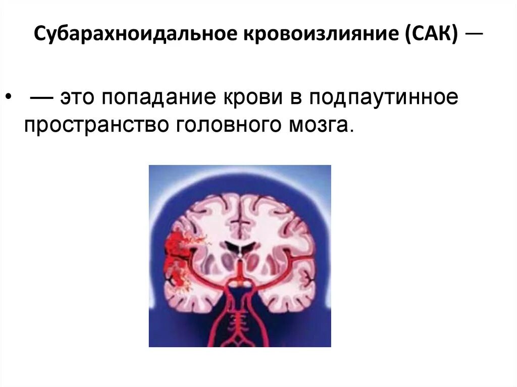 Субарахноидальное гематома. Субарахноидальное вентрикулярное кровоизлияние. Сак субарахноидальное кровоизлияние на кт. Субарахноидальный инсульт кт.