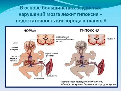 Гипоксия у новорожденных