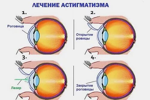 Можно делать операцию на глаза при астигматизме