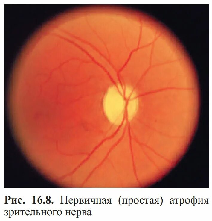 Тип зрительного нерва. Атрофия зрительного нерва Лебера. Атрофия зрительного нерва Лебера генетика. Офтальмоскопия при атрофии зрительного нерва. Физиологическая экскавация зрительного нерва.