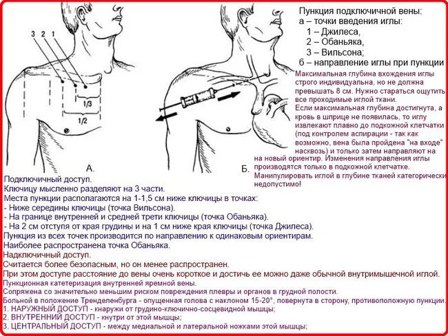 Алгоритм введения катетера. Катетеризация подключичной вены алгоритм. Пункция по Сельдингеру подключичной артерии. Пункция подключичной вены техника. Пункция подключичной вены алгоритм.