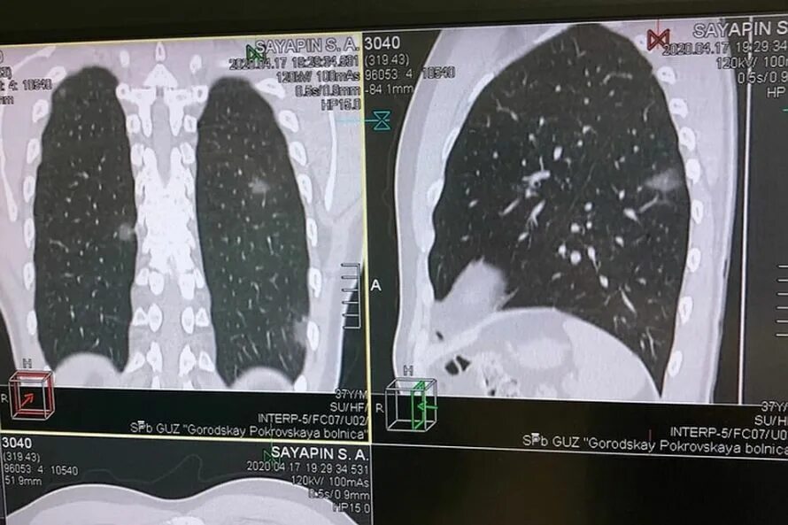 кт при коронавирусе степени поражения. поражение легких при ковиде. поражение лёгких при пневмонии. поражения легких прикорона. поражение легких при коронавирусе на кт.