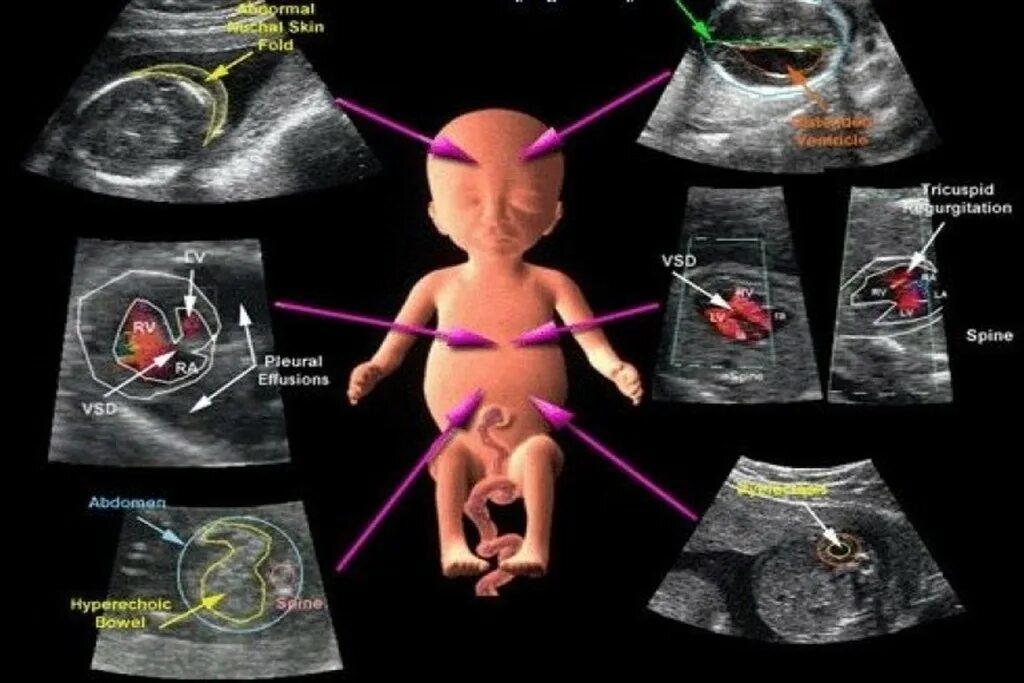 Как делают доплер. УЗИ С доплером при беременности. Ультразвуковая допплерография маточно-плацентарного кровотока. УЗИ плода с доплером что это. Допплеровское УЗИ при беременности.