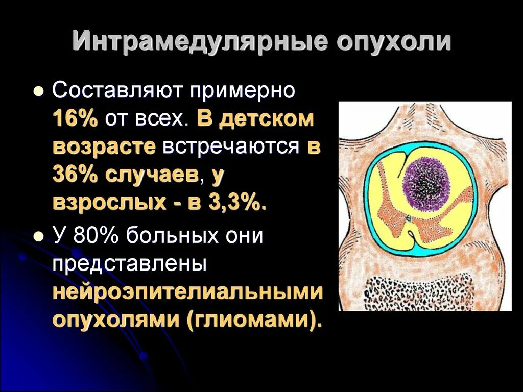 Классификация опухолей спинного мозга неврология. Интрамедуллярная опухоль спинного мозга дифференциальный диагноз. Объемное образование спинного мозга. Интрамедуллярного объемного образования спинного мозга. Интрамедуллярные опухоли спинного