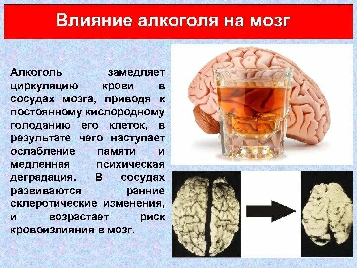 Влияние алкоголизма на головной мозг.