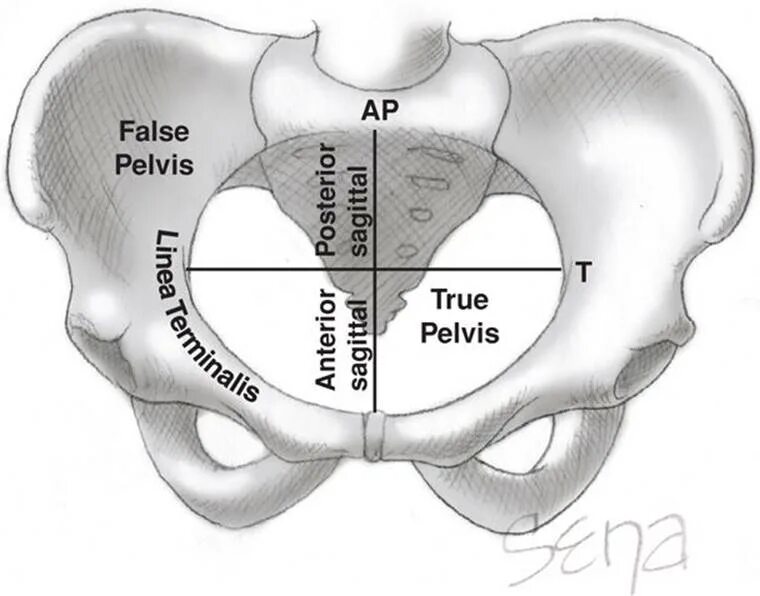 False view. Тазовая кость linea terminalis. true pelvis. inlet таз. false pelvis.