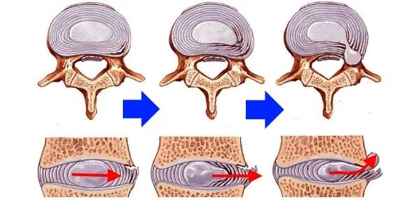 Лазерная вапоризация грыжи межпозвоночного диска. Лазерная операция на грыжу позвоночника. Нуклеопластика межпозвонкового. Операция лазером на позвоночнике грыжа. После операция грыжа диска