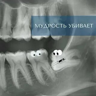 Лечу зуб мудрости