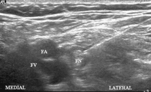 Блокада под узи. Блокада бедренного нерва под УЗИ. Синдром карпального канала на УЗИ. Ультразвуковая анатомия бедренный нерв.