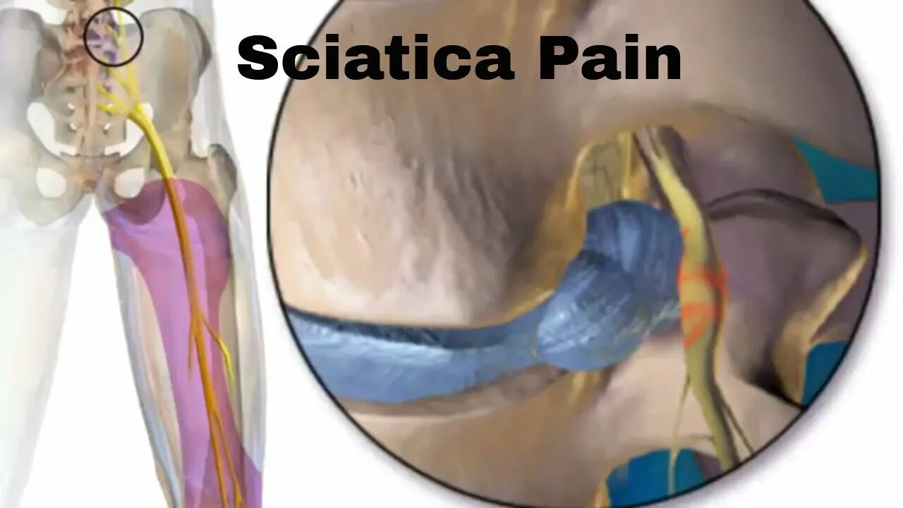Сильно болит седалищный нерв. Ишиас - защемление седалищного нерва. Защемление седалищного нерва s1. Ишиас тазобедренного сустава симптомы. Радикулопатия седалищного нерва.