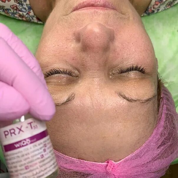 Prx пилинг эффект. Prx пилинг эффект. Микронидлинг с prx-t33 до после. Пилинг prx-t33. Prx-t33.