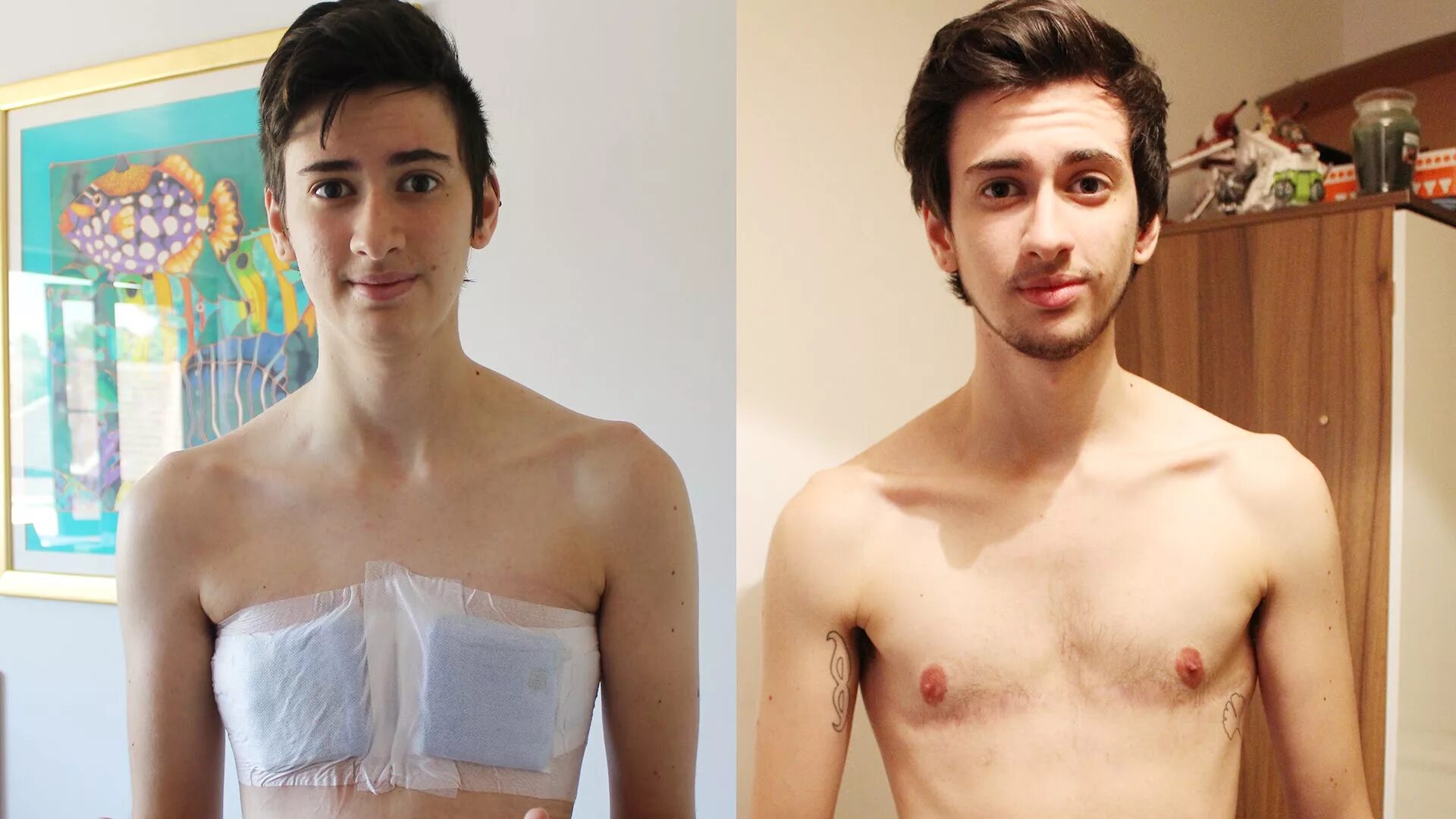 Мужчины после операции. ФТМ Джейми 18 +. Трансгендер ftm операция. Женские гормоны для мальчиков.