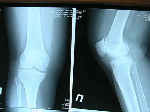 stryker knee :: Behance