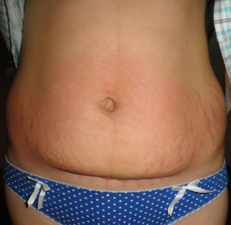 Растяжки после беременности. Почему в животе после. Почему в животе после. Диастаз белой линии у беременных. Почему в животе после.