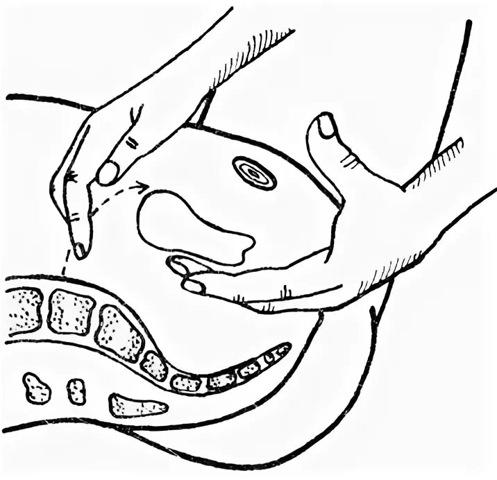Техника массажа матки. Висцеральный массаж матки.