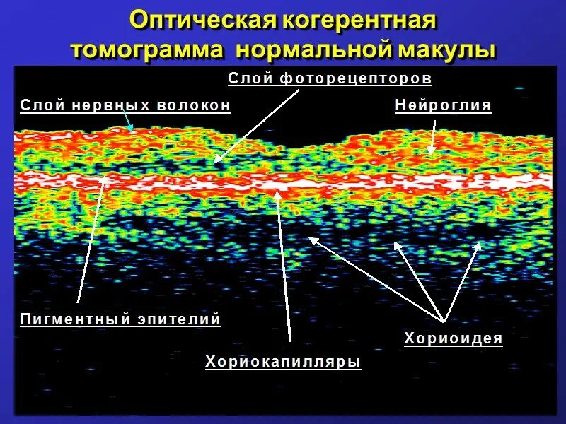 Окт макулы что это. Расшифровка оптической когерентной томографии сетчатки. оптическая когерентная томография сетчатки (окт). оптическая когерентная томография (ост) зрительного нерва. когерентная томография сетчатки глаза норма.
