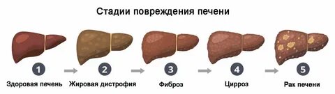 4 стадия печени